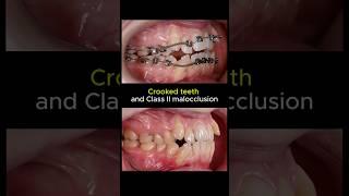 Braces for crooked teeth. 36 months duration #braces #orthodontist #dentist