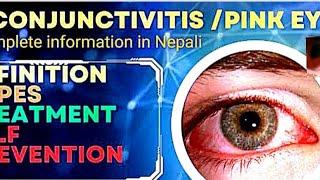 Conjunctivitis in Nepali |आँखा किन पाक्ने गर्छ। #eyeflu #conjunctivitis |Type|cause|Treatment|