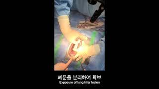 45kg 버니즈 마운틴독의 폐부엽 절제술