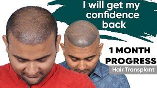 Hair Transplant in Chandigarh | Best Results & Cost of Hair Transplant in Chandigarh