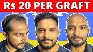 My Hair Transplant Cost Of 3500 Grafts | Best Hair Transplant Results In Ahmedabad & Surat