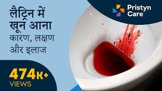 लैट्रिन में खून आना - कारण, लक्षण और इलाज | Blood in Stool| For Free appointment call: 9821-388-242