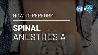 How to Perform Spinal Anesthesia