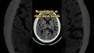 Acute Infarct Brain Radiology