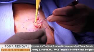 Lipoma Removal | Lipoma Surgery Performed By Dr. Firouz