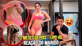 ANTES E DEPOIS RESULTADO LIPO HD  | *ele falou a real!*