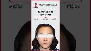 일주일이면 브이라인 완성!  실리프팅 l 얼굴형관리 l 탄력관리