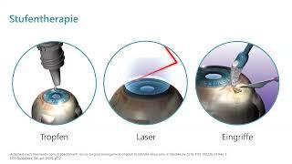 Endlich keine Augentropfen mehr? Aktuelles von den Vorderkammer-Implantaten bei Glaukom