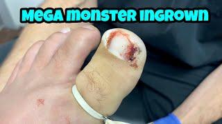 EXTRACTION OF BILATERAL MEGA INGROWN TOENAILS