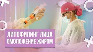 ЛИПОФИЛИНГ ЛИЦА / ОМОЛОЖЕНИЕ ЛИЦА СОБСТВЕННЫМ ЖИРОМ / РЕЗУЛЬТАТ ДО ПОСЛЕ #абриелль #кочнева