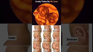 Twins baby movement in 4D scan #baby #movement