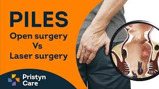 Which Piles Treatment is Better - Open Surgery or Laser Surgery? | Call : 9821388242