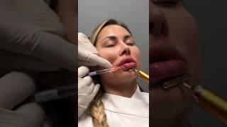 Restylane Refyne for Lip Enhancement - Painless Technique Dr. Steven F Weiner