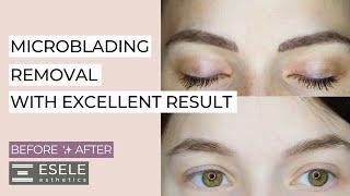 How to Remove Microblading? Tattoo Removal. Low-Quality Permanent Makeup.