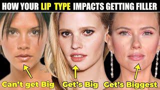 Is your Lip Type a good match for Filler?- How your Lip Type Impacts getting Lip Filler