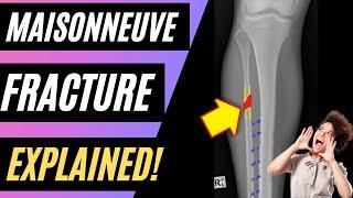 What is a MAISONNEUVE FRACTURE?