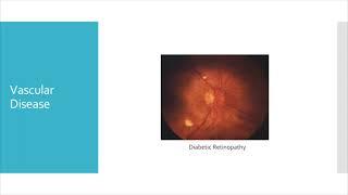 Management of Acute Vision Loss in ED