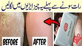 Do This Simple Home Remedy With Lifebuoy Soap|| Home Remedy to Remove Cracked Heels Fast Overnight|