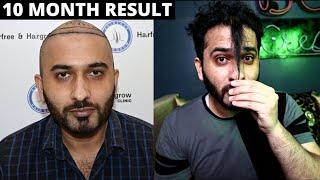 MY HAIR TRANSPLANT 10 MONTH RESULT | Medication i use | Born Creator