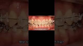 치아랑 교정장치 부딪히면 어떻게 해요?