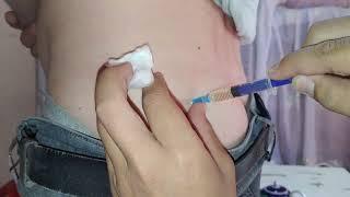 Intramuscular injection.  injection in the buttock