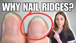 Why You Have Vertical Nail Ridges And How To Get Rid Of Them