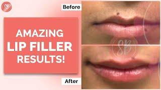 Amazing Results for Lip Filler | Lip Filler Surgery | Best Cosmetic Clinic in Gurgaon| SB Aesthetics
