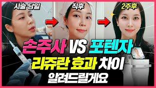 [리쥬란X포텐자] 셀프 시술 후 2주간의 리얼후기 알려드립니다! 리쥬란 시술방법 [손주사 vs 포텐자] 효과 뭐가 더 좋을까?