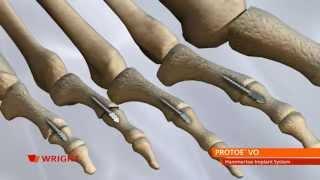 PRO-TOE™ VO Hammertoe Implant System Animation