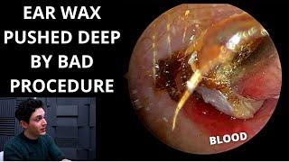 Ear Wax Pushed Down By Negligent Procedure (Ear Impressions/Mouldings)