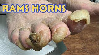 RAMS HORNS NAILS ON MULTIPLE TOES