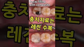 충치치료는 레진수복이 최선! 크라운, 인레이는 불필요함. 16_2024_06_17