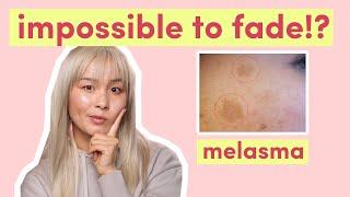 Melasma & hyperpigmentation | What can you do to fade melasma!?