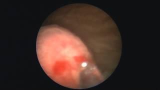 Ureterocele incision with Thulium laser and holmium laser lithotripsy, Dr. Farid Gadimaliyev
