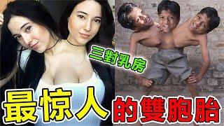 世界上“最罕见”10大连体人，三对乳房的连体人你见过？三头六臂的人类真的存在#top10 #世界之最 #科普 #地球最top #腦洞大開 #非洲 #动物