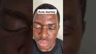 Acne Journey Credits : Perfect clinic via IG #acnejourney #acnetreament