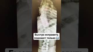 Сколиоз? #юмор #зож #сколиоз