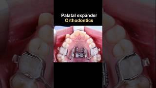 Expander jaw when orthodontics #braces #orthodontist #dentist