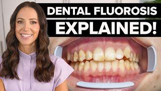 Is Drinking Water Ruining Your Teeth? (Dental Fluorosis Explained)