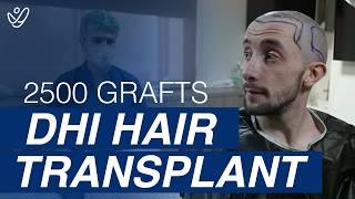 2500 Grafts DHI Hair Transplant Surgery *MUST SEE*