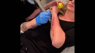 StudioMD Tattoo Removal