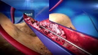 AngioJet™ Peripheral Thrombectomy System   Boston Scientific