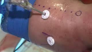 MEDHOLD paradigm hip system product video 1