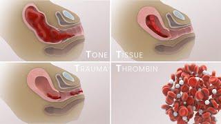 Management of Postpartum Hemorrhage (PPH) | Etiologies, prevention, treatment | TVASurg