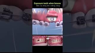 Cách kéo răng mọc ngầm khi niềng răng #shorts #braces #orthodontist