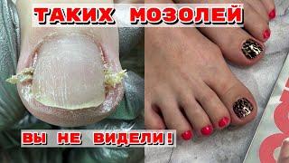 ОГРОМНЫЕподногтевые мозоли‼️ПЛЁНКИ в педикюре