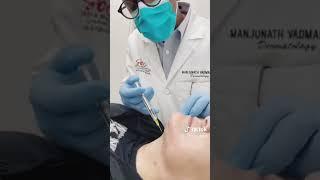 Kybella (double chin treatment)