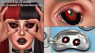 ASMR 큰 렌즈 함부로 끼면 안 되는 이유! 눈 감염의 원인인 렌즈 제거 애니메이션 | 다래끼 치료 | Big Contact Lens Removal | Stye Treatment