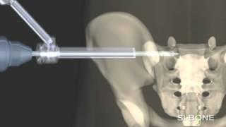 iFuse Implant System - Minimally Invasive Sacroiliac Joint Surgery