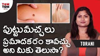 Facts About Birth Marks By Torani Makana || TomTom Facts